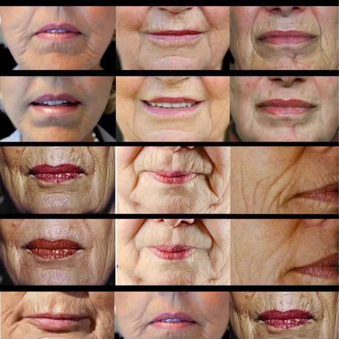 Numbers Reveal Lifting Breakthrough Is Replacing Fillers